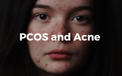 PCOS and Acne